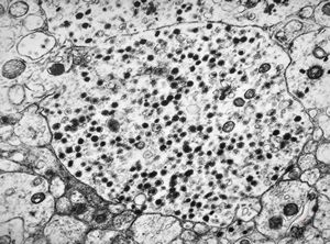 M, 3y. | suprarenal neuroblastoma